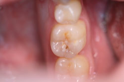 Tooth with decay visible